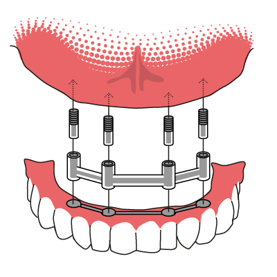 Veranschaulichung der Funktionsweise einer Stegprothese, die auf Zahnimplantaten befestigt wird.